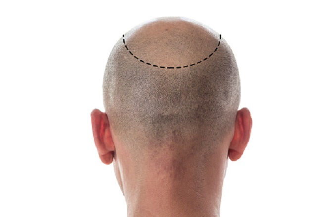 Is a Hair Transplant minimally invasive?