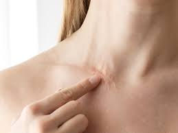 Surgical Scar Revision: Expert Techniques to Restore Skin