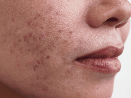 What happens during a pigmentation treatment?