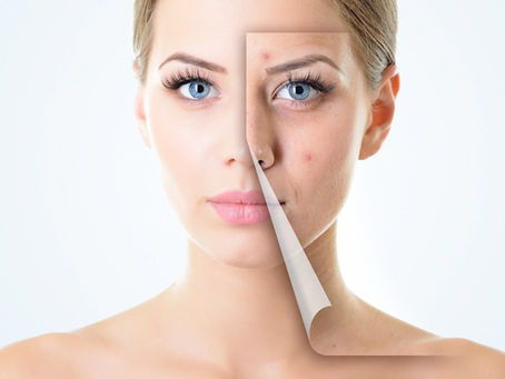 Acne Scar Treatment Dubai: Safe and Effective