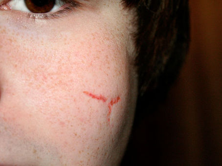 How to Find the Best Surgeon for Facial Scars Dubai