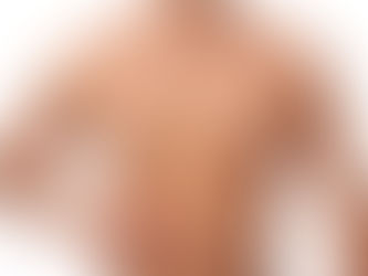 GPS Laser Liposuction: The Future of Precision Fat Removal