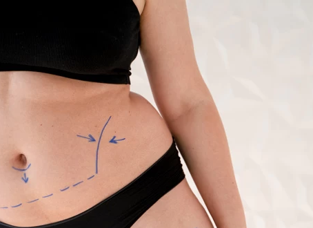 When Can You Return to Work After Liposuction
