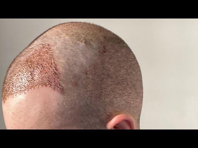 What happens during Hair Transplant surgery?