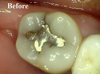 Silver Filling