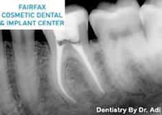 Root Canal Dr Adi