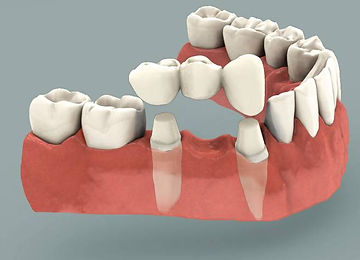 Dental Bridge