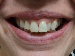 Anterior Teeth Make-Over Before A