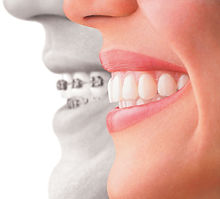 Braces Invisalign Compare