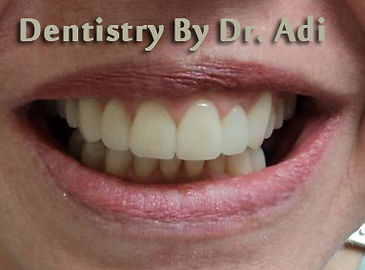 Dental Veneers After
