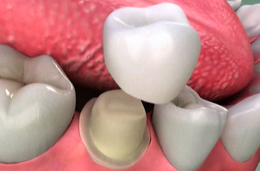 Dental Crown