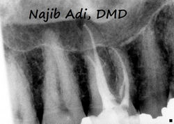 Excellence in Root Canal Treatment