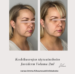 Keskikasvojen täyteainehoito Vilma