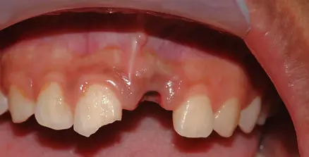 Avulsion-Dental.webp