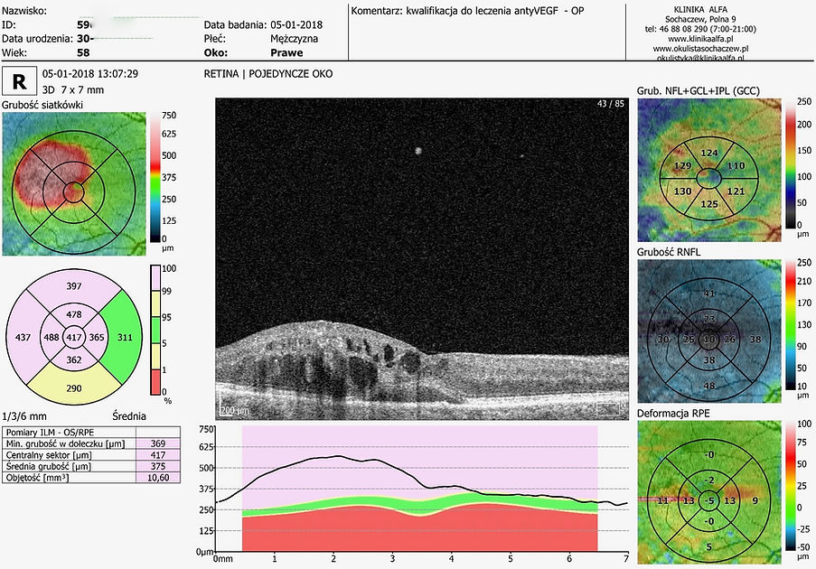 OCT plamki, amd, zwyrodnienie plamki