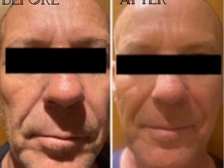 Sunekos® case study