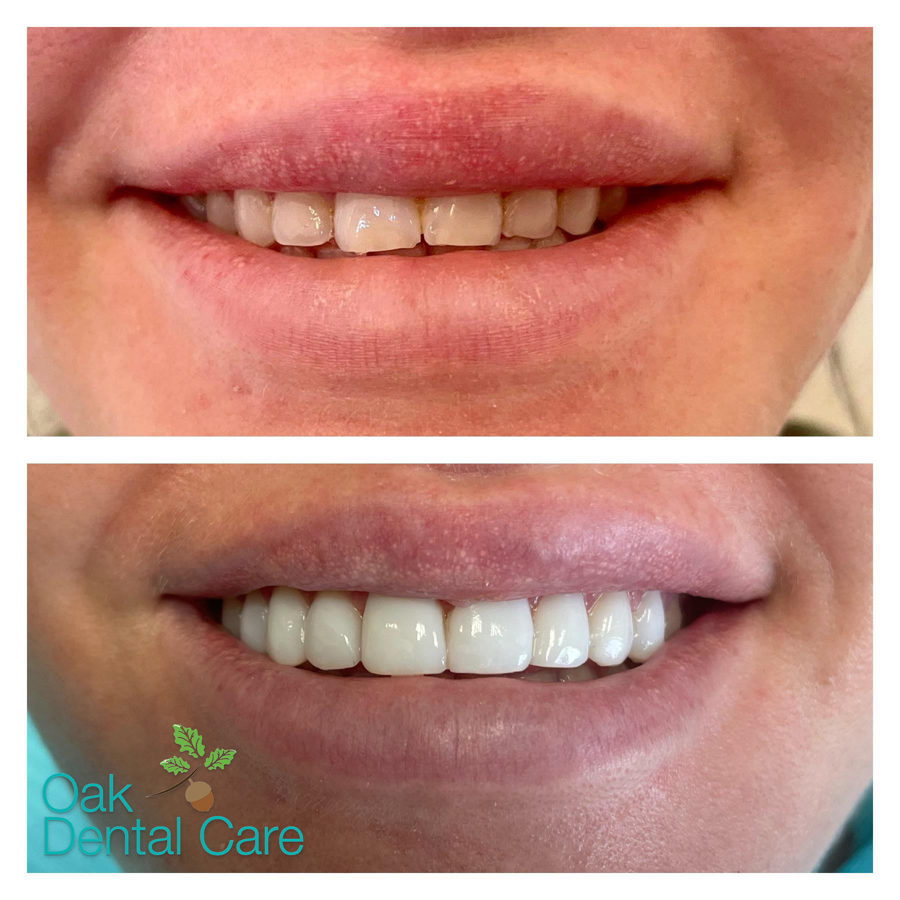 Smile before and after cosmetic treatment