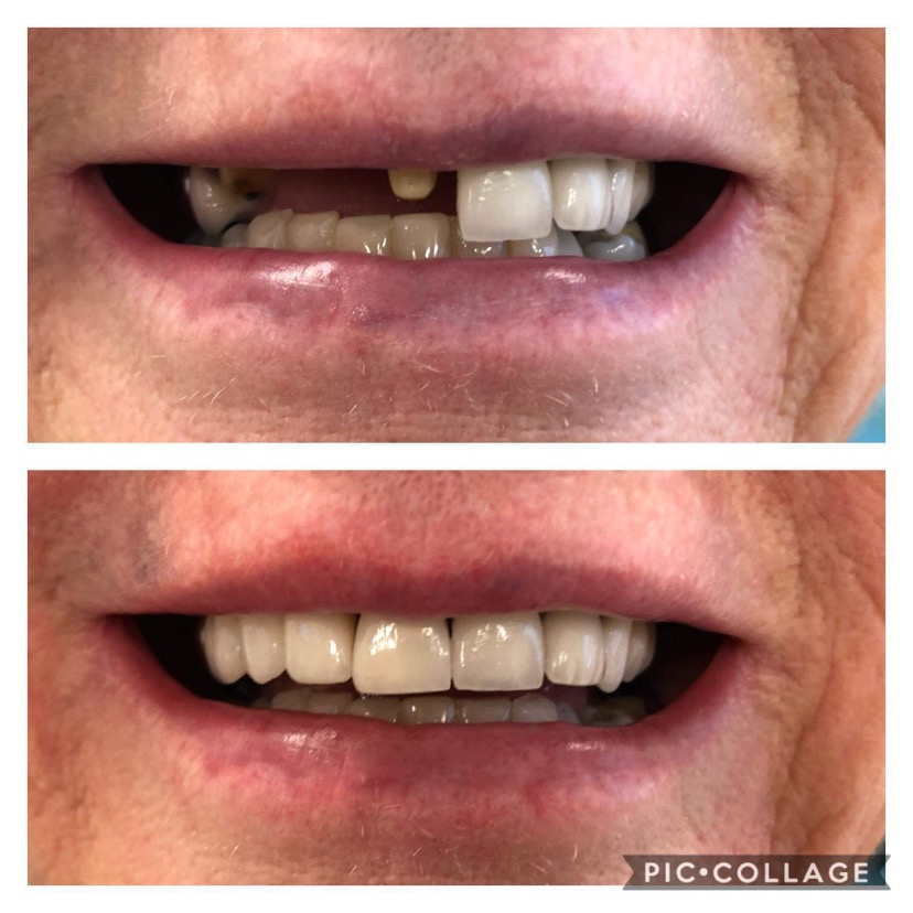 Smile before and after restorative treatment