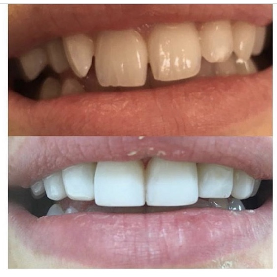 Teeth before and after composite veneers