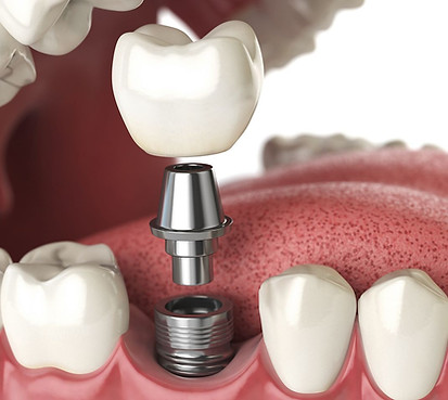 Dental Implants, Dentist, Southport, oak dental care, dental surgery