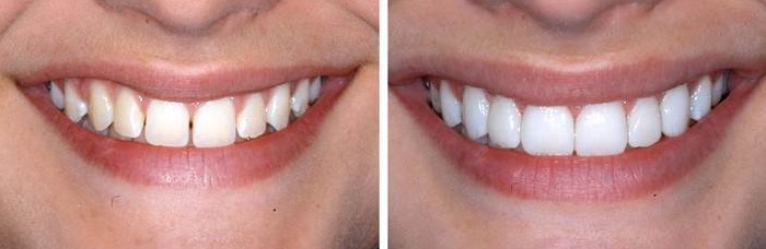 Before and after composite veneers and whitening