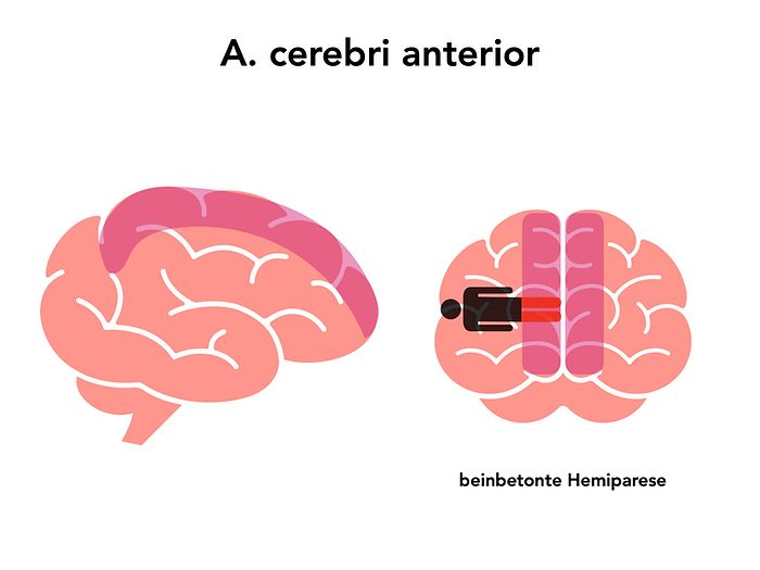 Infarkt A. cerebri anterior, Anteriorinfarkt