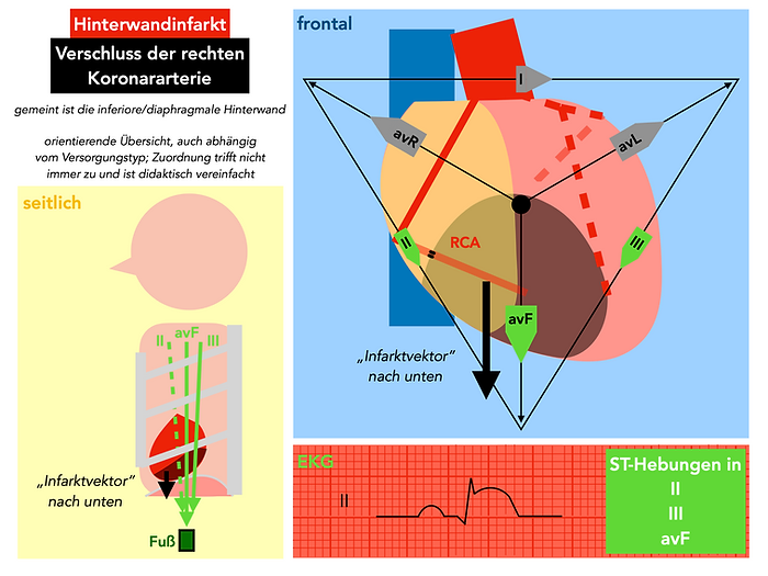 Hinterwandinfarkt, STEMI, RCA