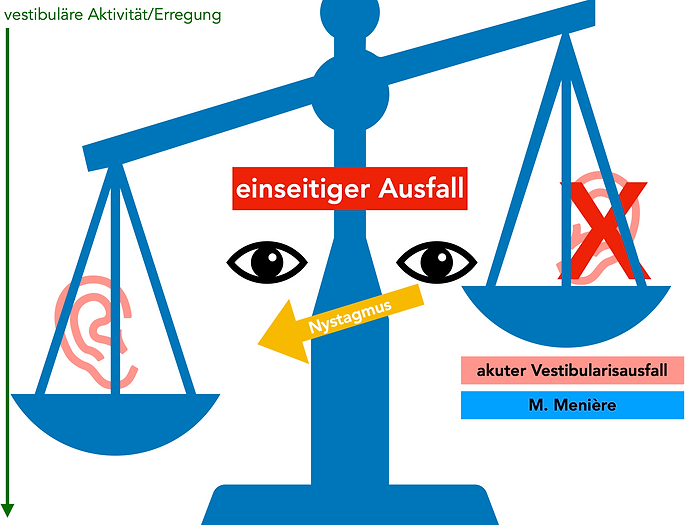 Nystagmus bei Vestibularisausfall, M. Menière