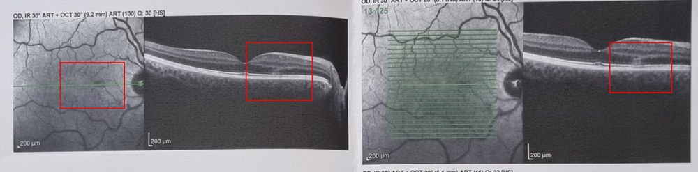 Immer mehr unscharfe Flecken im Gesichtsfeld | Augenarzt Online