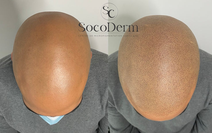 Micropigmentation effet rasé calvitie