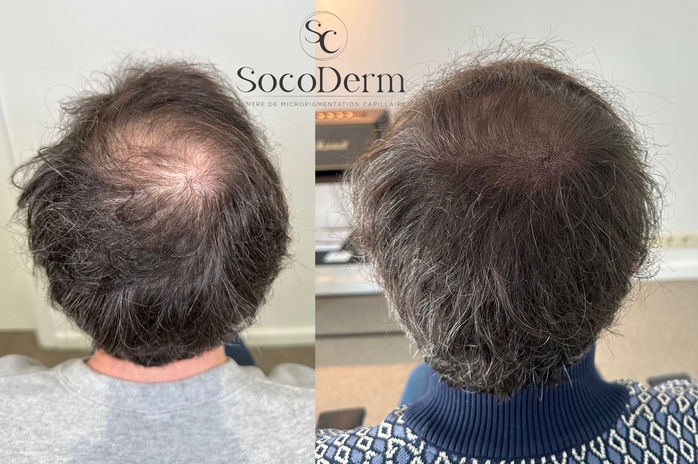 Micropigmentation effet densité homme