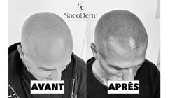 Dermopigmentation