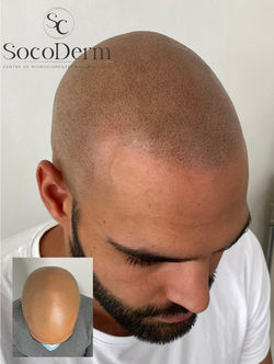 Tricopigmentation