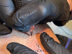 Tricopigmentation: La solution à vos problèmes de calvitie