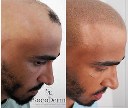 Micropigmentation