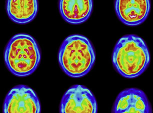 molecular imaging pet scan