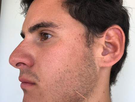 Rechinas los dientes? sabes lo que es el Bruxismo?