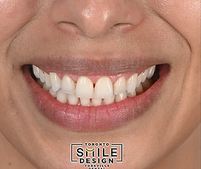 Fixing the black triangles between teeth gaps by porcelain veneers.001.jpeg