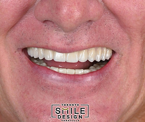 All on X Dental Implants in Toronto_edited.jpg
