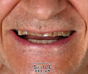 Fixing Teeth Erosion with Dental Veneers and Porcelain Crowns.png