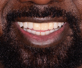 Veneer Toronto - Pre op - Intraoral Pic 