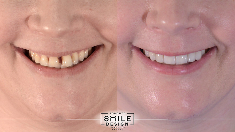 Before and after pictures of a Smile Makeover with Porcelain Veneer and Dental Bridges