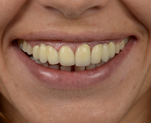 Veneer Toronto - Pre op - Before Portre