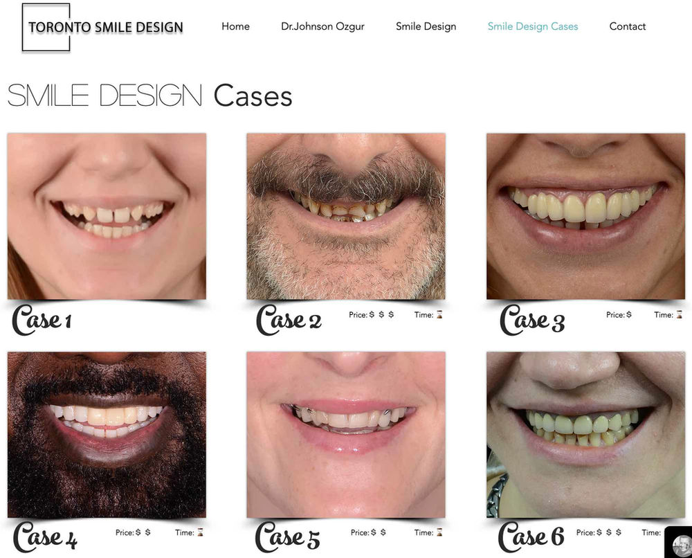 Dental Veneers Pros and Cons