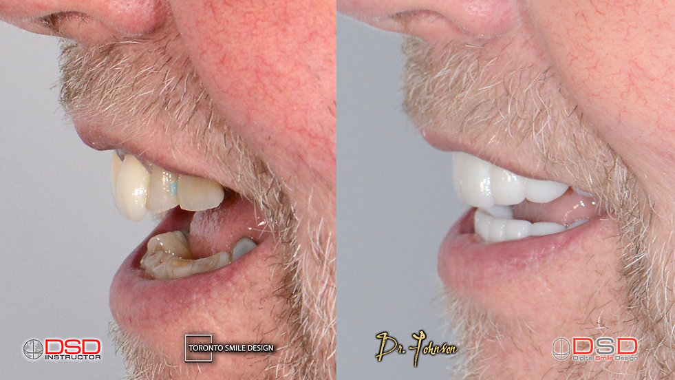 Cosmetic Dentistry Toronto Case 9 - Toro