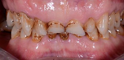 Veneer Toronto Pre-op - Before Picture.p