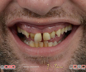 Cosmetic Dentistry Toronto - Porcelain Crowns 
