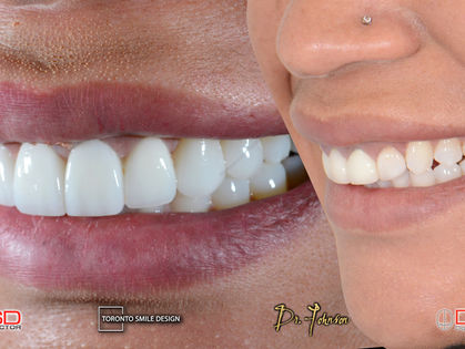 Gummy Smile: Laser Gum Contouring and Other Treatment Options