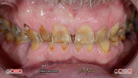 Dental Crown.012.jpeg