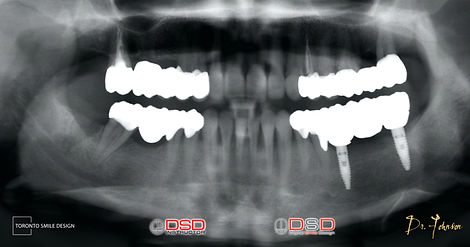Implant Toronto - After Implant Surgery